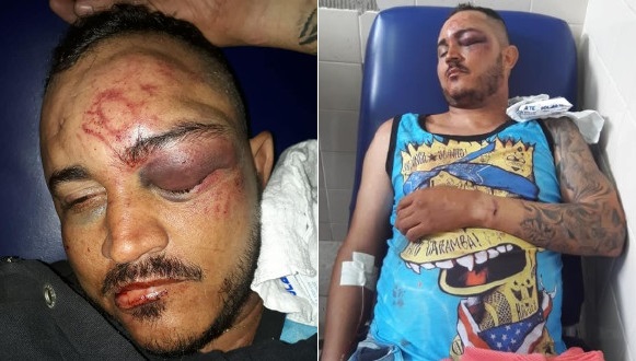 Paulo Afonso: mulher desabafa ao mostrar esposo com rosto ‘arrebentado’ em bloco de Carnaval