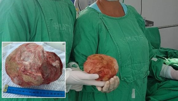 Lavrador de 51 anos tem pedra de 1,3 Kg e 18 cm retirada da bexiga em cirurgia na Bahia