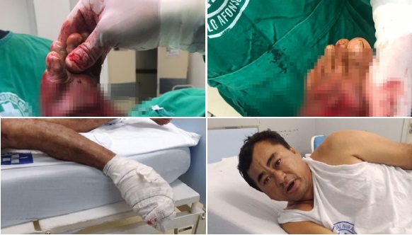 Paulo Afonso: popular “China” tem pé dilacerado em acidente de moto e imagens impressionam