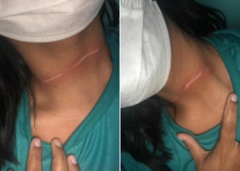 Jovem tem pescoço cortado ao ser atingida por linha de pipa em Paulo Afonso