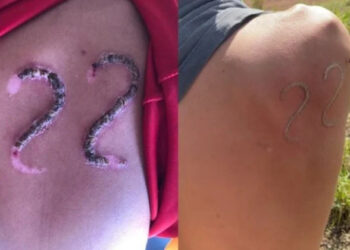 Jovem usa ferro em brasa para ‘tatuar’ 22 de Bolsonaro após ser desafiado por amigos de esquerda