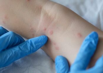 Terceiro caso de varíola do macaco é confirmado na Bahia