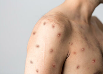 Inhapi e Pariconha, no Sertão de AL, registram casos suspeitos de varíola dos macacos, diz Sesau