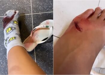 Mulher faz apelo às autoridades após ser mordida e atacada por cerca de 15 cachorros em Paulo Afonso