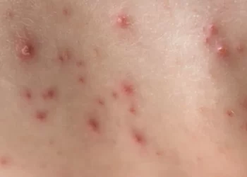 Sesab emite alerta sobre notificações de catapora na Bahia; estado tem 443 casos