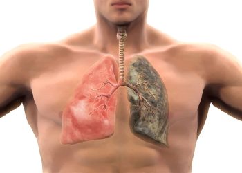 Câncer de pulmão – Por Francisco Nery Júnior